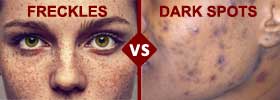 Freckles vs Dark Spots