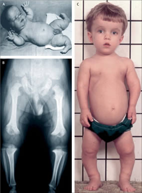 achondroplasia dwarfism people